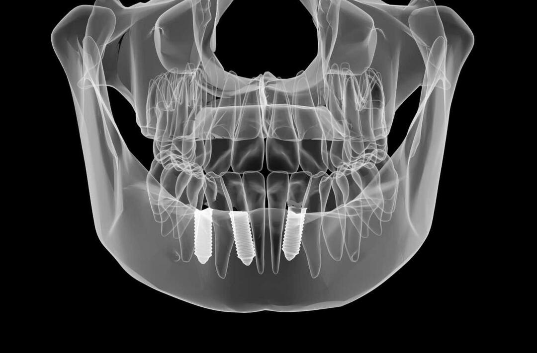 ما الذي يتم قبل وبعد علاج زراعة الأسنان؟