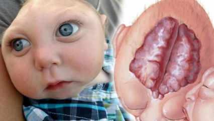 ما هو الدماغ؟ ما هي أعراض دماغ الدماغ عند الرضع والأطفال؟ أسباب الدماغ هو ...