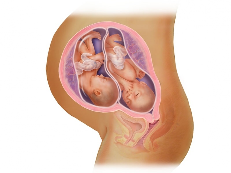 الحمل التوأم في IVF! ما هو نقل الأجنة؟