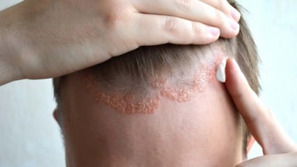 ما هي أعراض التهاب الجلد الدهني ومن تظهر؟ الأطعمة التي تسبب المرض