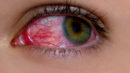 ما الذي يسبب حساسية العين؟ ما هي اعراض حساسية العين؟ ما هو جيد لحساسية العين؟ 