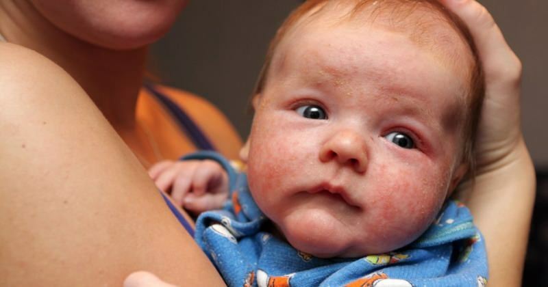 أسباب احمرار العين عند الرضع