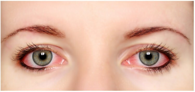 هل حساسية الماسكارا والعينين في العين؟
