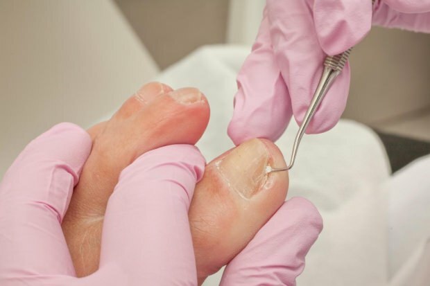 ما أسباب ظهور أظافر أصابع القدم تحت الجلد وما هي الأعراض؟ طرق طبيعية مفيدة للأظافر الناشبة ...