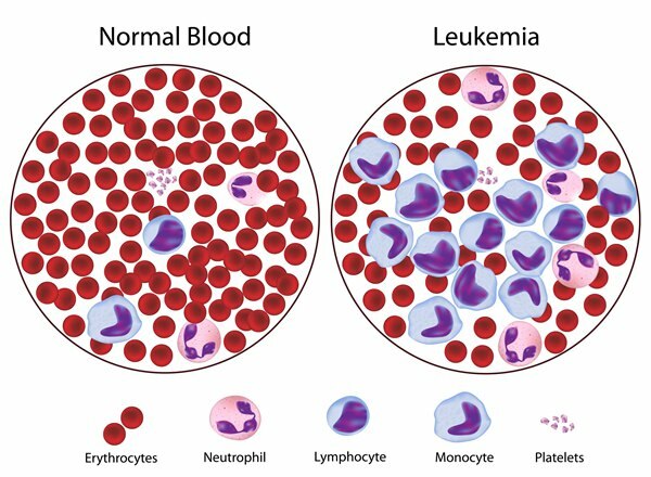 ما هو سرطان الدم؟