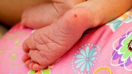 لماذا يؤخذ دم الكعب عند الرضع؟ متطلبات فحص دم الكعب عند الرضع
