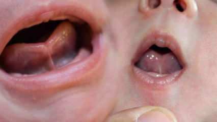 ما هي رابطة اللسان (Ankyloglossi) عند الرضع؟ أعراض وعلاج اللسان اللسان ...