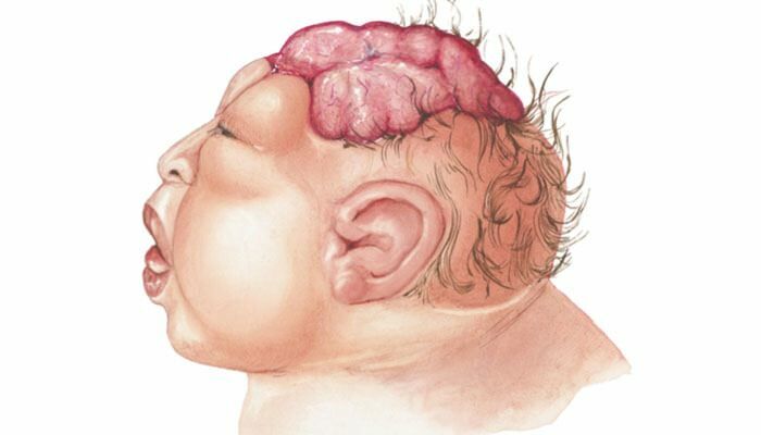 ما هو الدماغ؟ ما هي أعراض دماغ الدماغ عند الرضع والأطفال؟ أسباب الدماغ هو ...