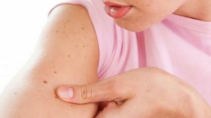 ما هو سرطان الجلد وماهي أعراضه؟ طرق لفهم سرطان الجلد