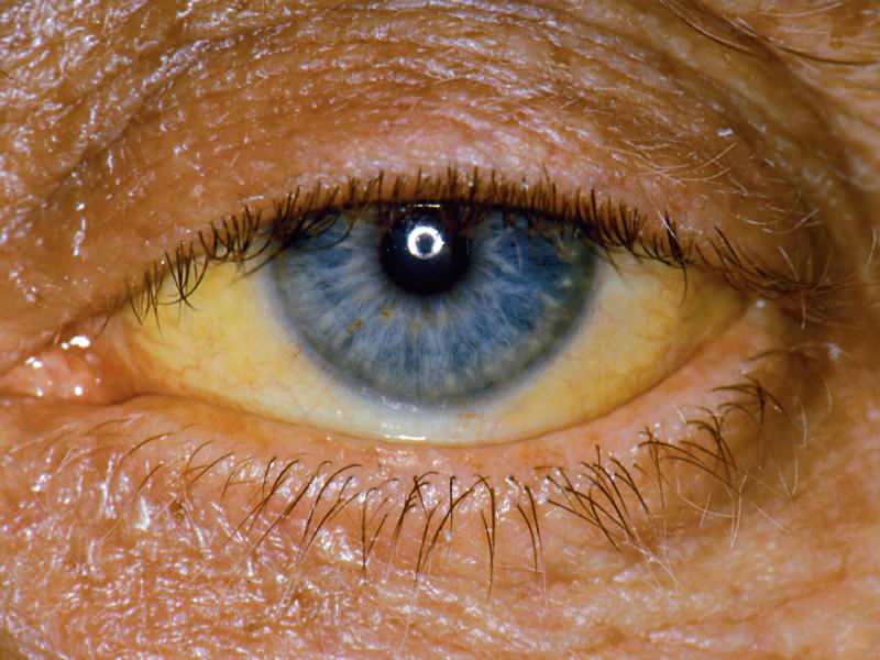 الارتفاع عند مستوى البيليروبين يسبب لونًا أصفر للعينين والجلد