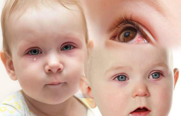 يسبب نزيف العين عند الأطفال