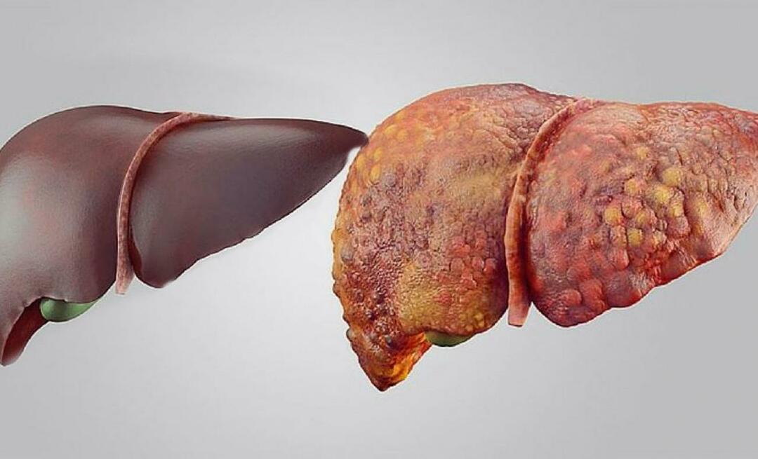 ما هي أعراض الفشل الكبدي؟ كيف يتم علاج فشل الكبد؟