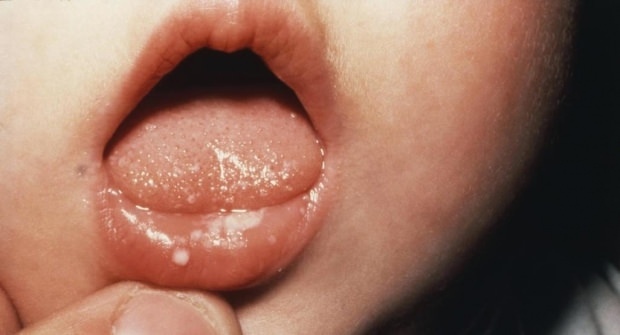 كيف يؤلم الفم عند الأطفال