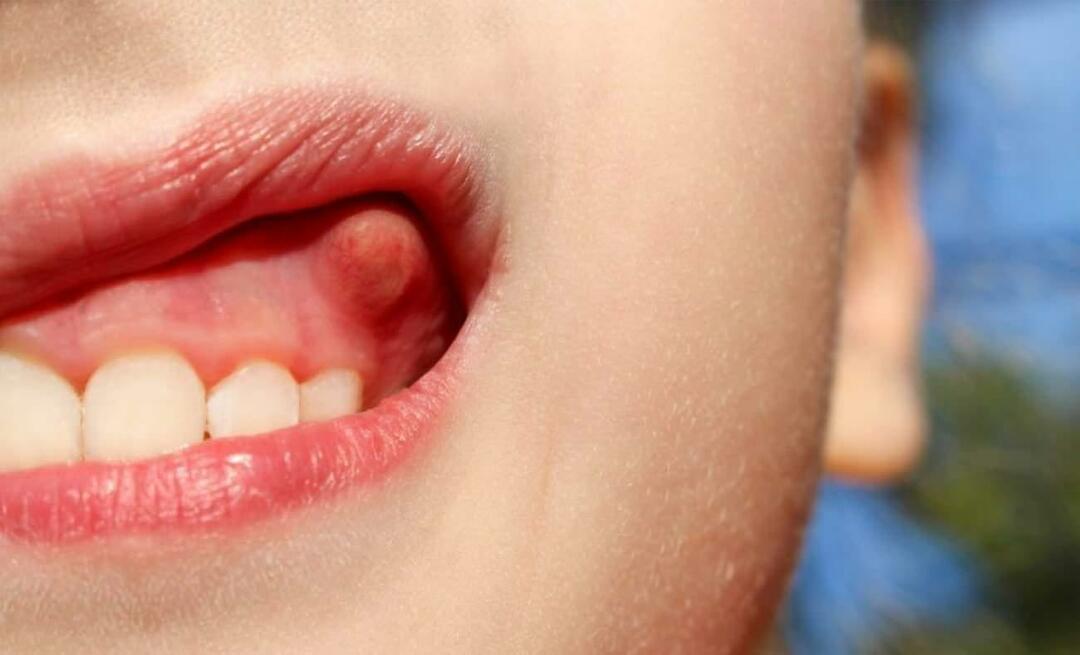لماذا يحدث خراج الاسنان وما هي اعراضه؟ خراج الاسنان كيف يتم علاجه؟
