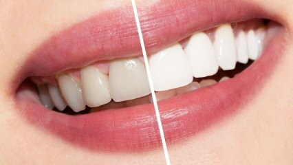 ما هي توصيات الأسنان البيضاء؟ علاج تبييض الأسنان بشكل طبيعي في المنزل ...