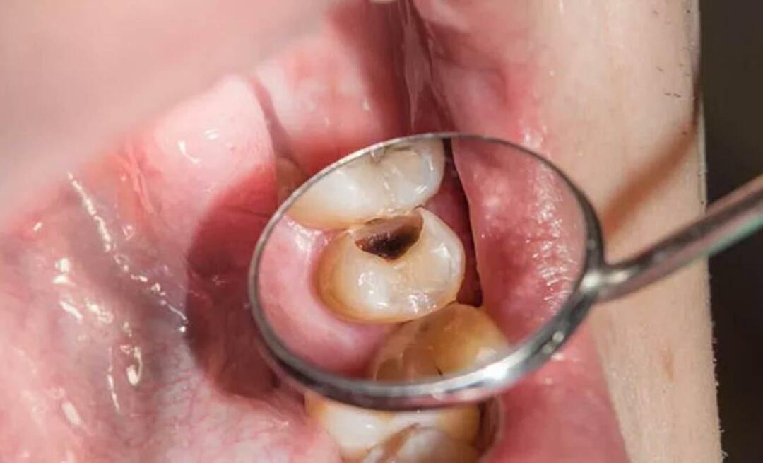 لماذا تتعفن الأسنان وماذا يمكننا أن نفعل لمنع ذلك؟ 