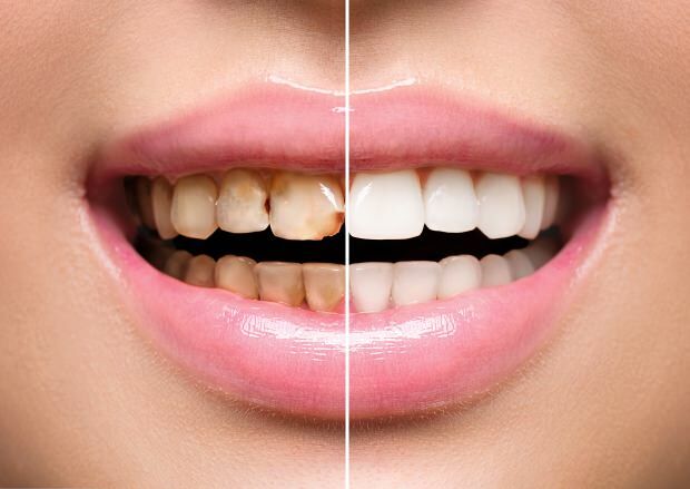 نتيجة للتغذية غير الصحية ، يحدث كل من تلون الأسنان وفقدانها