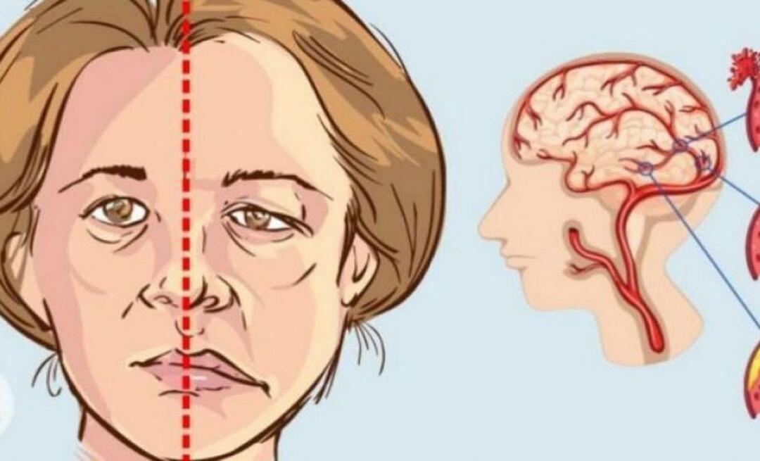 ما هي السكتة الدماغية؟ ما هي أعراض السكتة الدماغية؟ كيف تمنع السكتة الدماغية؟
