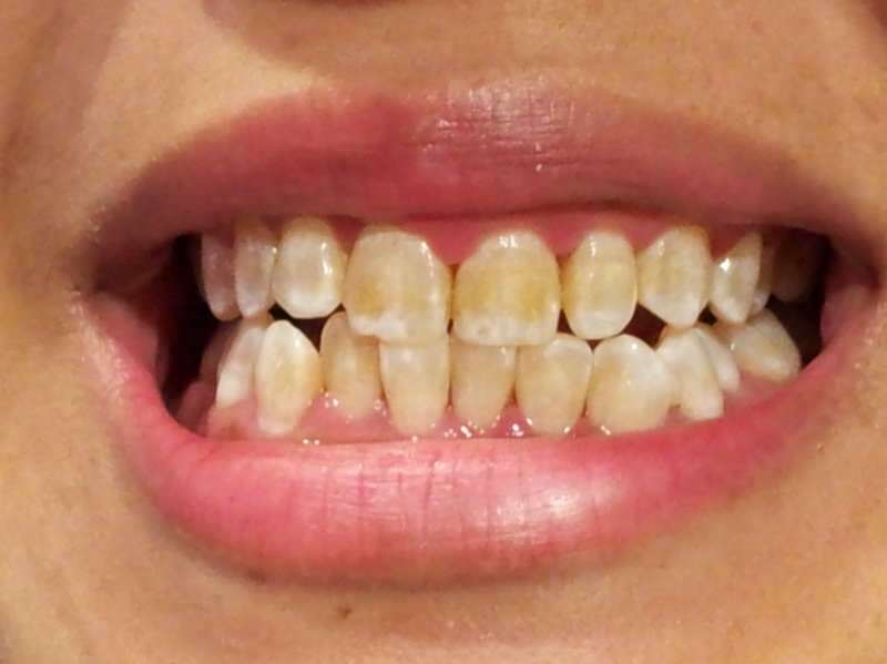 صورة أسنان شخص تبدأ أسنانه بالظلام