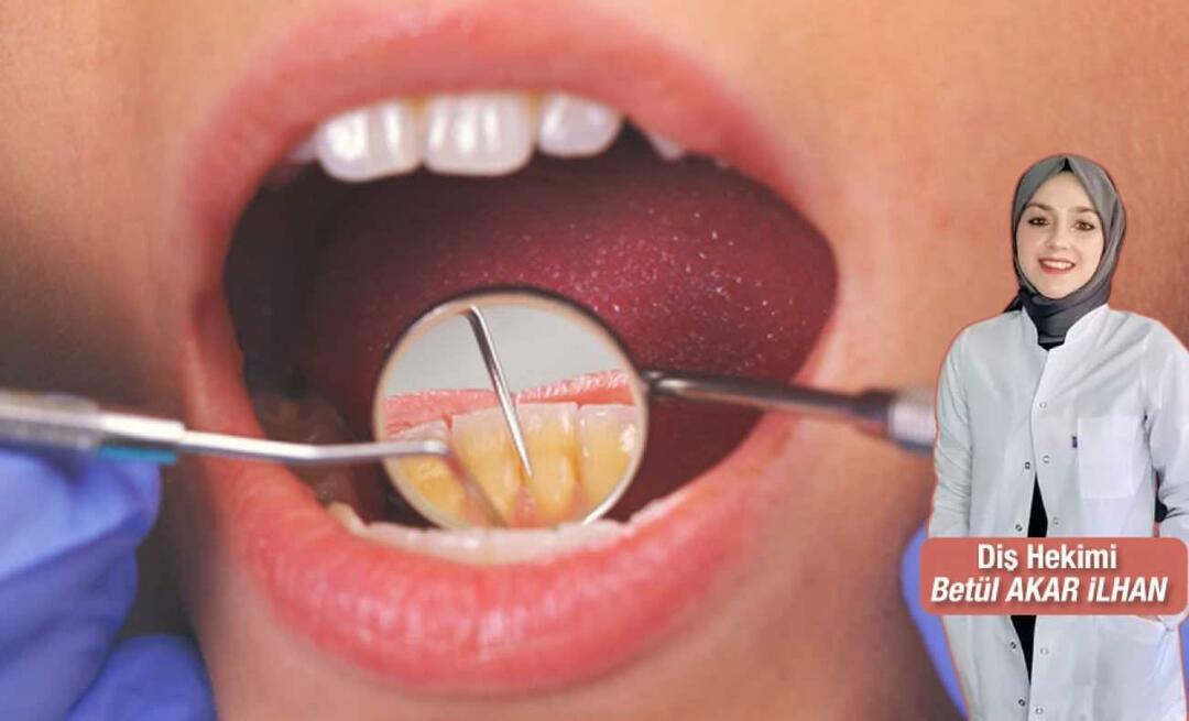ما الذي يجب فعله لتجنب الجير؟ ما هي فوائد تحجيم الأسنان؟