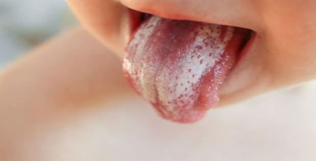 علاج الفطريات عن طريق الفم عند الرضع