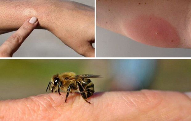 أعراض حساسية النحل