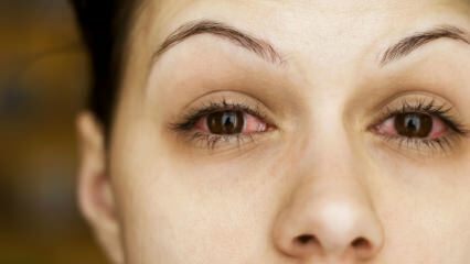 ما هو التهاب الملتحمة (أنفلونزا العين) وما هي الأعراض؟ كيف ينتقل التهاب الملتحمة؟